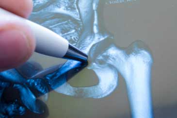 hip replacement surgery, orlando, total robotic hip replacement