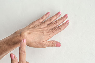 image of hand, ganglion cyst, hand, wrist